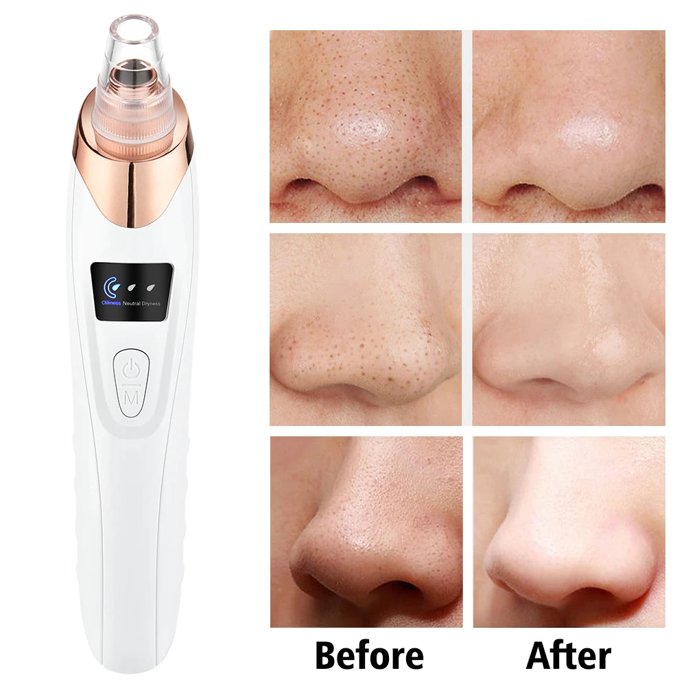 Electric Vacuum Suction Blackhead Remover Facial