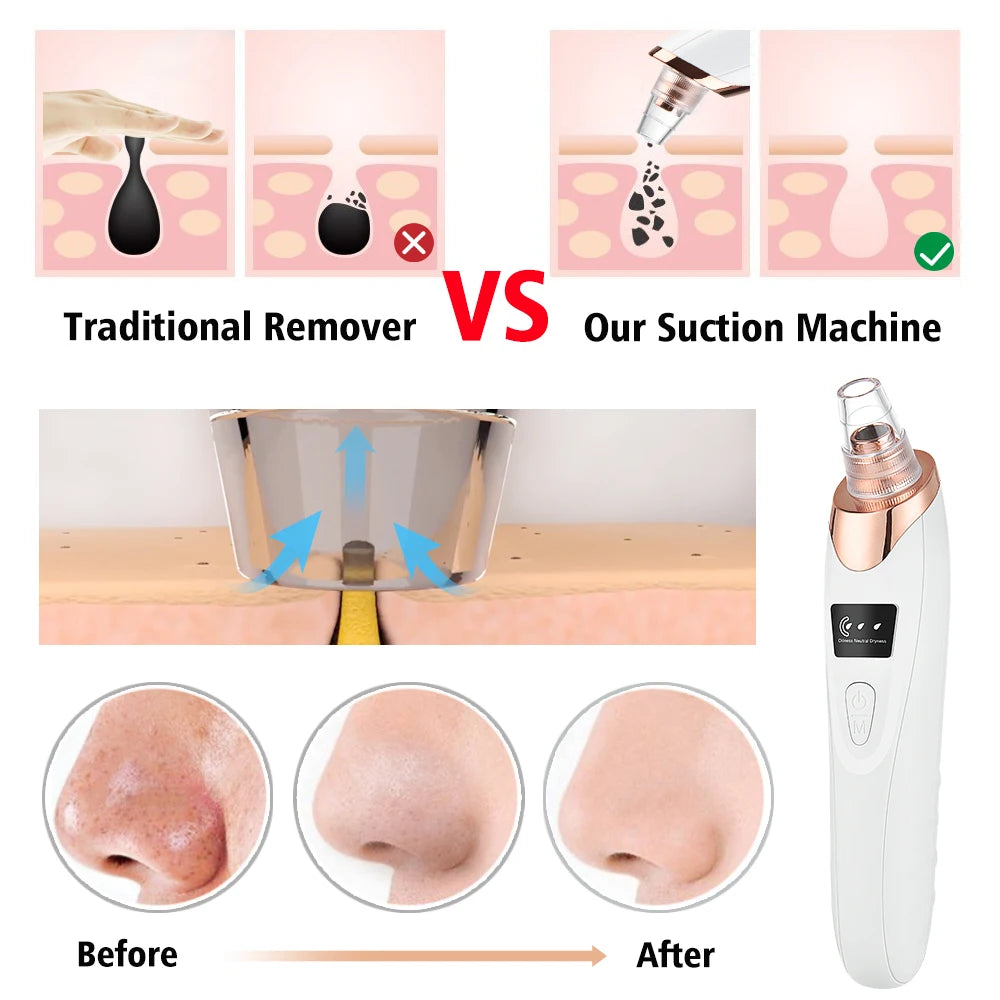 Electric Vacuum Suction Blackhead Remover Facial